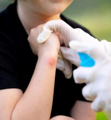 A healthcare provider wearing gloves sprays a solution on a child's arm, which has a red insect bite or skin irritation.